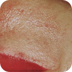 Laserové odstranění benigních kožních léz